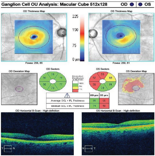 The lack of difference in average GCC thickness between early AMD and intermediate AMD eyes suggests to researchers that substantial inner retinal changes occur in the transition from normal aging to late AMD, with minimal variance between early and intermediate stages. This GCC scan is from a glaucoma patient not involved with this study.