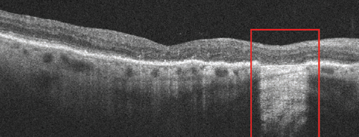 The study found significant progressive functional decline in scotopic visual acuity for patients with cRORA lesions; results with iRORA were more variable.