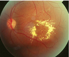 Intravitreal implant corticosteroids