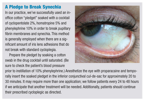 Intravitreal steroids macular edema