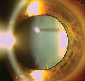 Steroid induced posterior subcapsular cataract