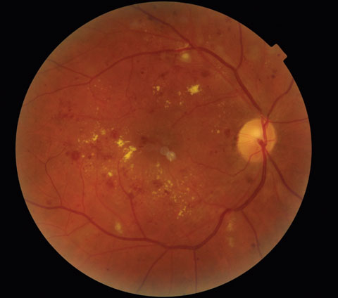 This patient’s last reported eye exam was in July 2014 at an unknown location.  Teleretinal imaging was performed in November 2014 and revealed severe nonproliferative diabetic retinopathy with probable clinically significant macular edema (CSME) in both eyes.