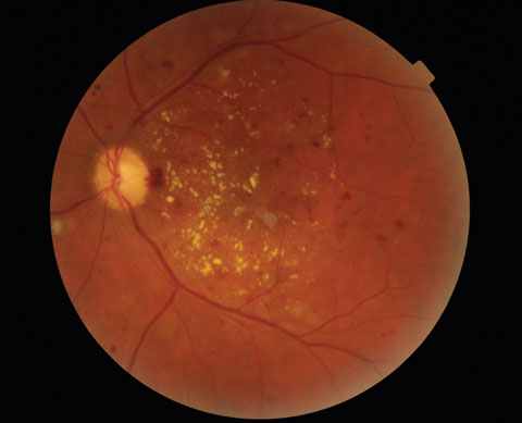 This image shows the left eye of the patient above. The patient was referred to a retinal specialist where OCT confirmed the presence of CSME OU and widefield angiography demonstrated retinal capillary nonperfusion in the periphery. Panretinal photocoagulation and intravitreal bevacizumab were performed in both eyes at follow-up.
