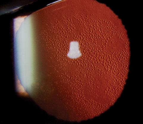 A case of Fuch’s dystrophy shown in retroillumination.