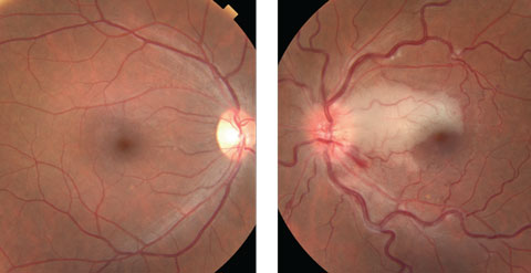 Figs. 1a and 1b. Fundus photo of the right eye (at left) was normal, but the left eye (at right) shows a large optic nerve edema, superior to the macula and infarction extending from the optic nerve to the nasal border of fovea.