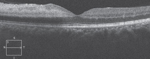 Fig. 2. OCT of the patient’s left eye.
