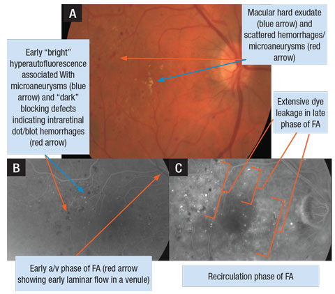 A. Retinal photograph of a patient’s right eye with DME. B. FA photo of early arteriovenous (a/v) phase OD. C. FA photo of later phase (recirculation) demonstrating extensive leakage of dye in the macula OD.