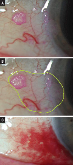 Figs. 2a-c (from top to bottom). Case 2 involved a small suspected CIN lesion discovered incidentally on exam. Treatment was initiated at INF-a2b QID until the 10mL bottle was empty. The estimated total extent of neoplastic margins is highlighted in green. Finally, resolution was seen, with concurrent SCH related to valsalva (not medication induced). Treatment required one month at one million IU QID and then 10 days QID at three million IU of INF-a2b. 