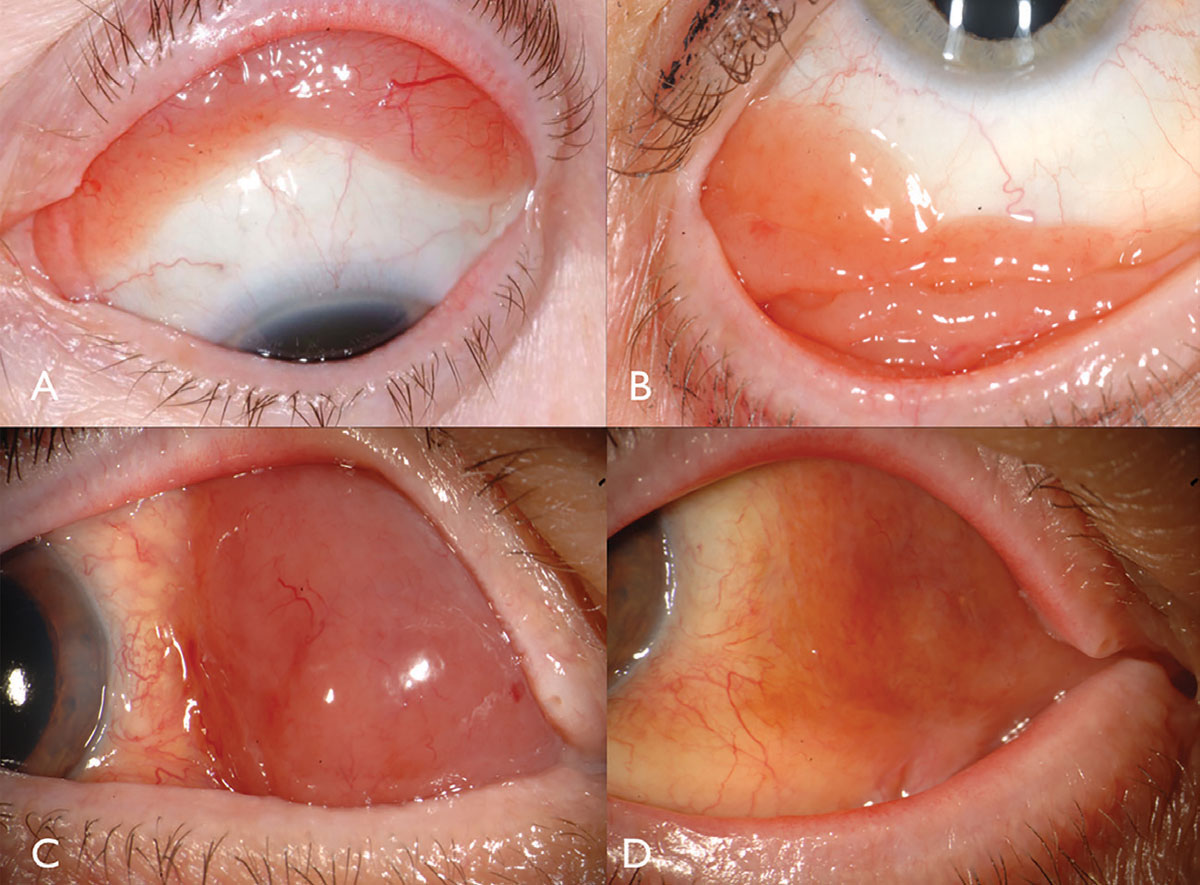 Fig. 2. Conjunctival lymphoma can be salmon-pink (A) or multilobulated forniceal (B). Medial forniceal conjunctival lymphoma before (C) and after (D) ritiximab.