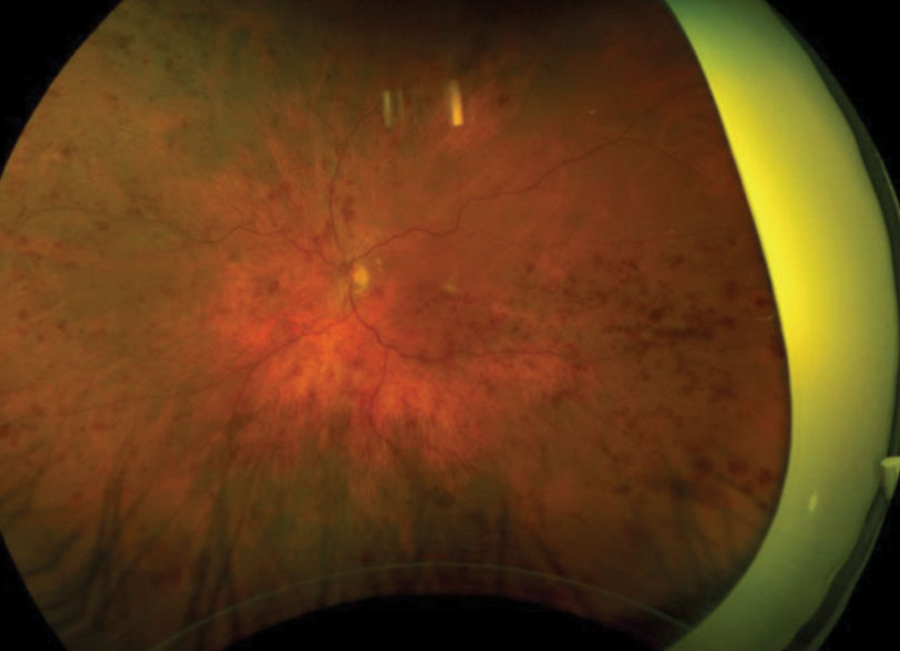 Fig. 1. This patient presented with retinal hemorrhages and cotton-wool spots in all four quadrants of his left eye. 