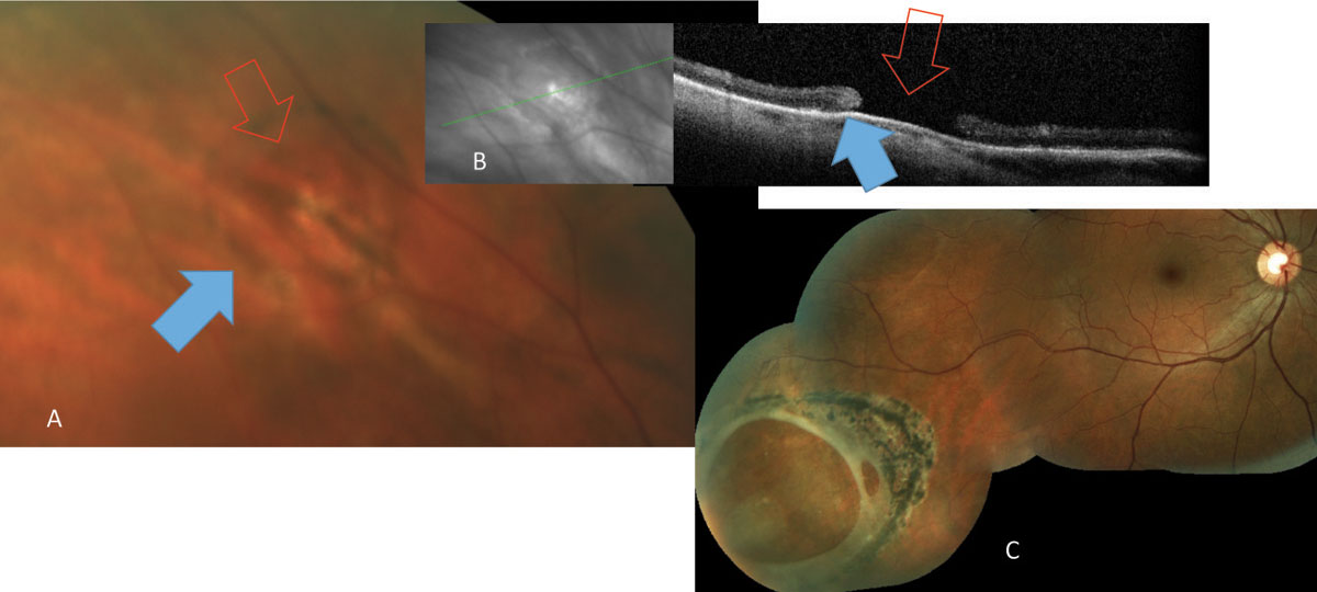 Fig. 1. Atrophic retinal hole (red arrows) noted both on (A) fundus photograph and (B) OCT. The ring of pigmentation (blue arrows) is a reactive repair due to separation of neurosensory retina and the retinal pigment epithelium. (C) A large atrophic hole noted in routine examination and subsequently treated with laser.
