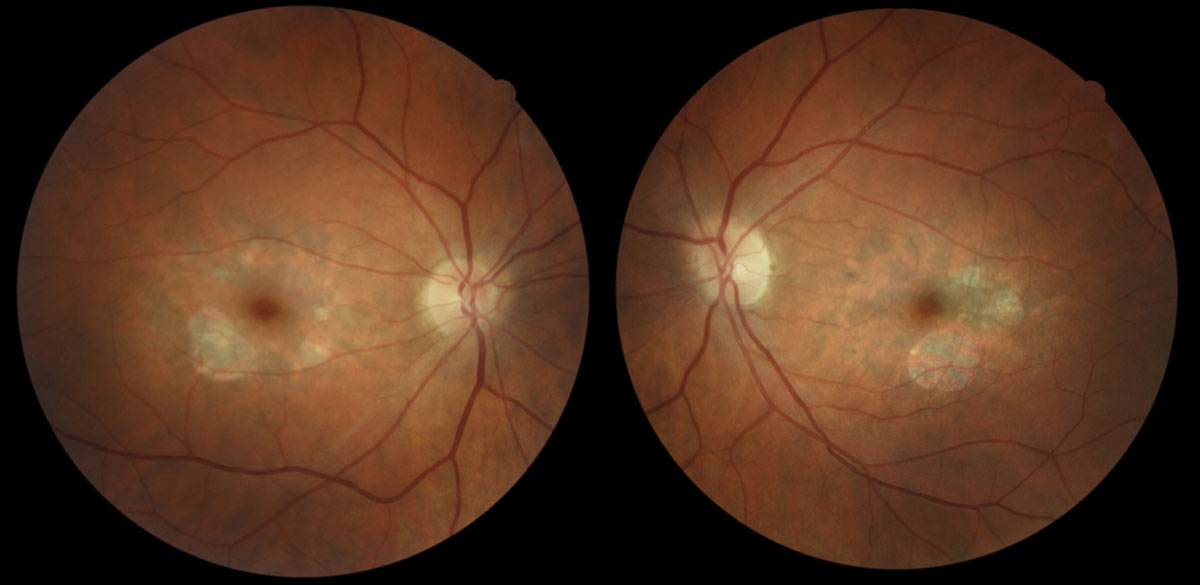 Fig. 1. Parafoveal RPE atrophy with scattered deposits in both eyes of a 43-year-old Caucasian female with butterfly pattern dystrophy. Her best-corrected visual acuity is 20/20 in each eye. 
