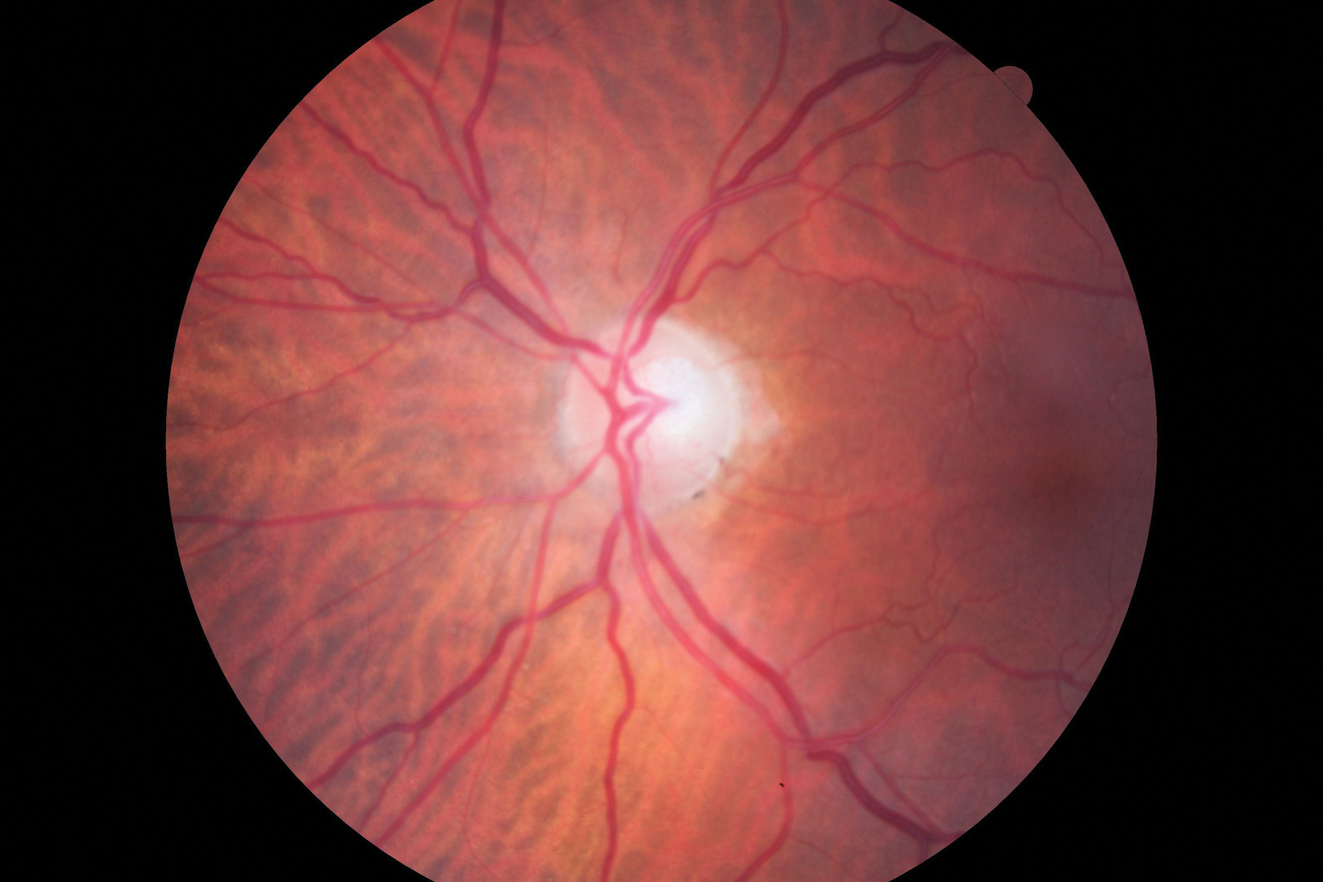 Fig. 1. Visible in this patient’s optic disc is a temporal pallor with numerous arterial constrictions and a/v nicking.