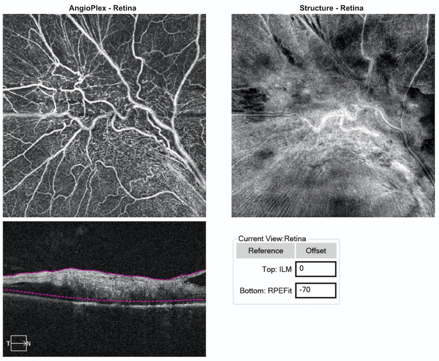 Fig. 3. These images represent 6x6mm OCT-A of the lesion. Note the findings within the sensory retina. 