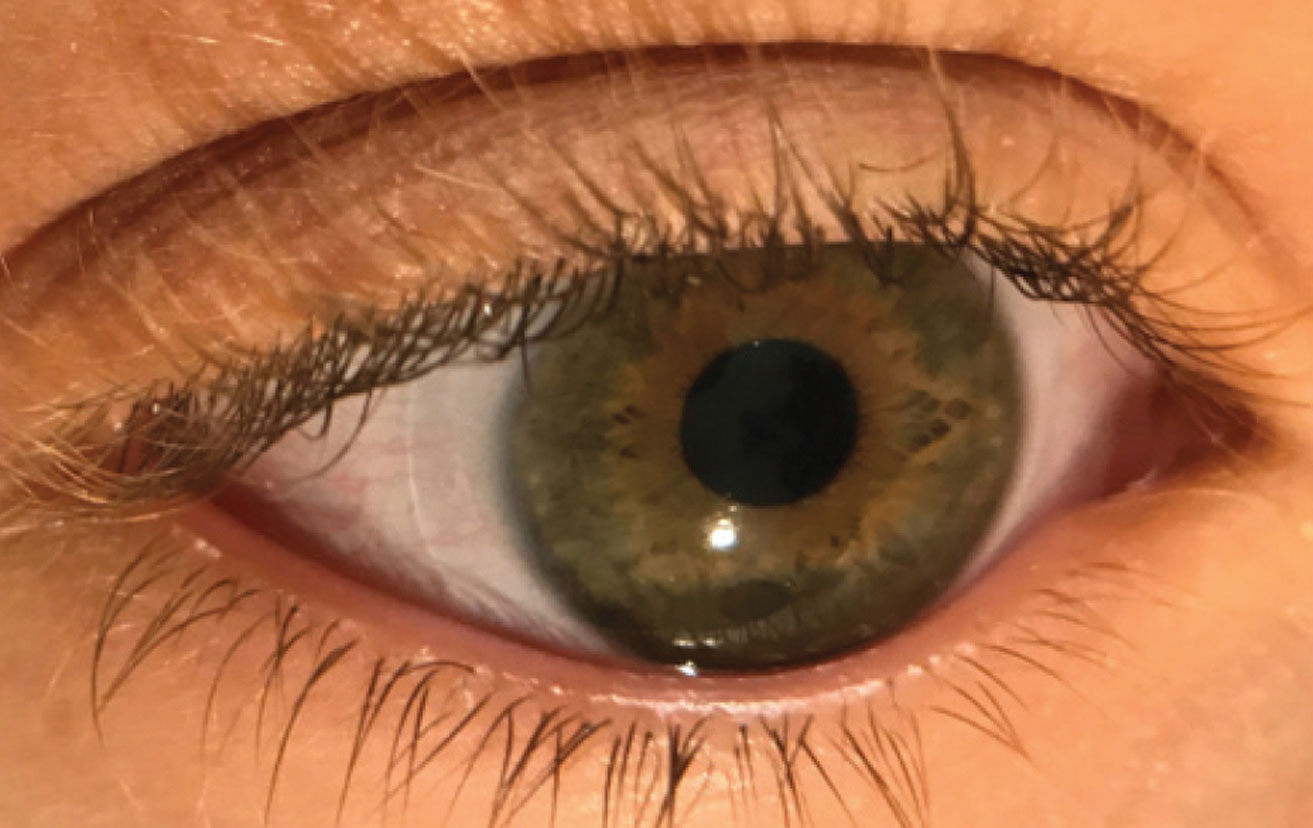 This patient’s larger-than-average horizontal visible iris diameter led to contact lens intolerance with traditional soft lenses. Her OD took the time to design a toric lens with an increased diameter, which did the trick.