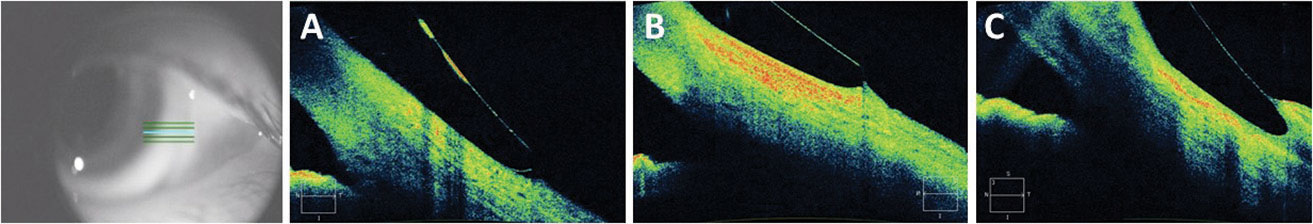 Fig. 6. Anterior segment 5-line raster images show a scleral lens edge that lands too flat and lifts away from the conjunctiva (A); good, stable landing aligned with conjunctiva (B); and impingement into the conjunctiva with a steep landing zone edge (C).