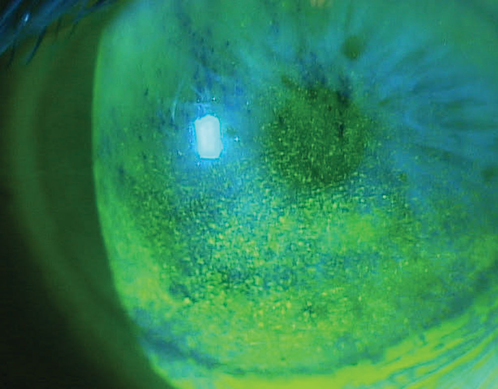 Corneal superficial punctate keratitis in a patient on multiple topical glaucoma medications.