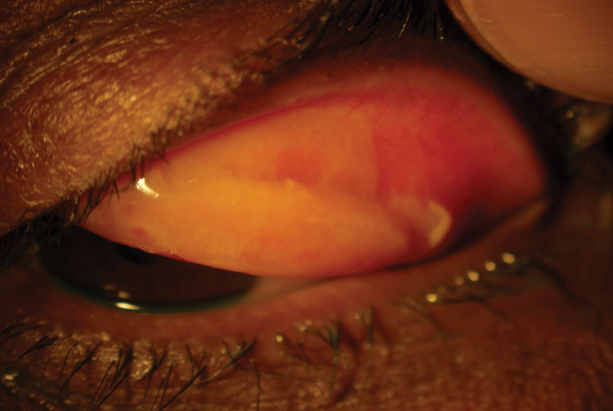 This 27-year-old patient’s persistent reddening and discharge was coupled with this finding, seen upon everting the eyelid.