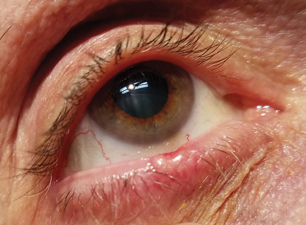 Basal cell carcinoma of the lower eyelid margin. Note the ulceration of the superior aspect, the lesion’s pearly elevated margins and madarosis.