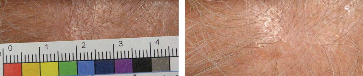 This patient with actinic keratosis of the scalp has a subtle lesion that is pinkish-tan and slightly elevated.