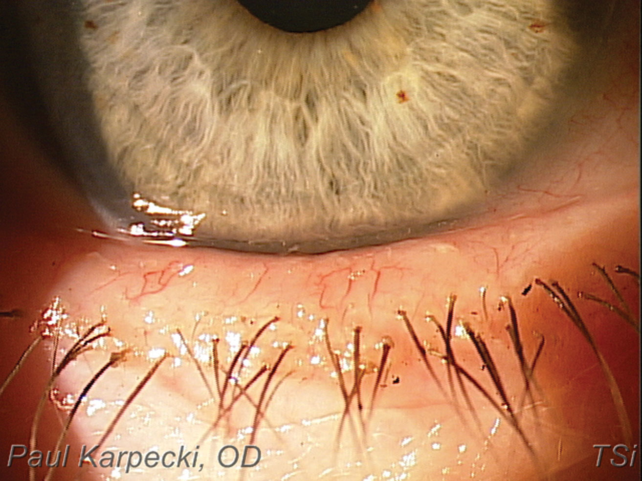 Telangiectasia and blepharitis in a patient with rosacea.