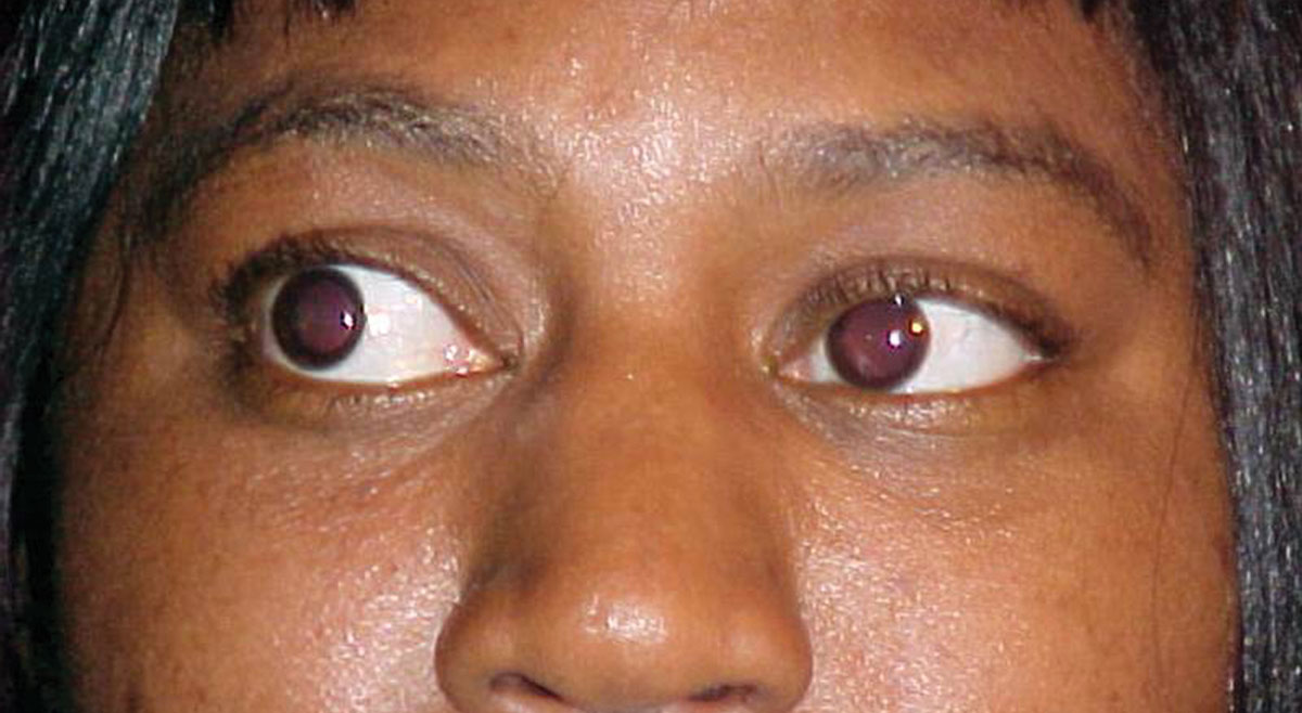What can this patient’s anterior segment presentation tell you about the likely cause of her dry and scratchy eyes?