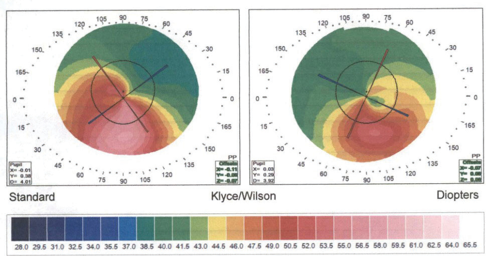 The corneal topography of a 20-year-old who has undergone CXL shows irregular inferior steepening consistent with keratoconus in the right eye more so than the left. Data collected annually will continue to assess for corneal stability vs. progression.