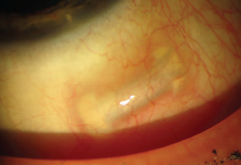 The VisAbility scleral inserts represent a new concept in presbyopic surgery currently undergoing FDA trials.