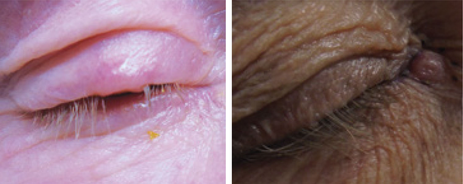 BCC of the upper eyelid, at left and the medial chanthus/nasal root, at right. Note the lesions’ pearly elevated margins.
