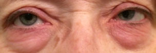 This patient is experiencing an allergic reactions on and around the eyelids as well as the conjunctiva. Upon allergen exposure the skin becomes red, tight and itchy.