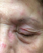 This patient displays herpes zoster virus of the forehead with ocular involvement. The eye is involved in approximately 75% of cases when the nasociliary nerve is affected.