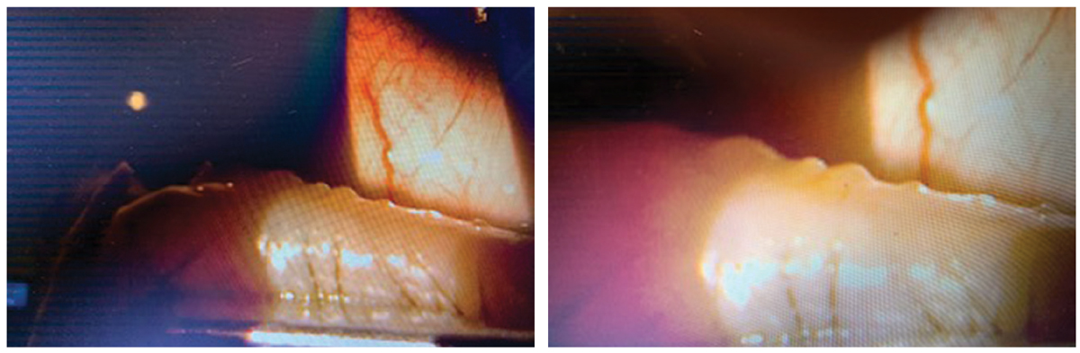 These slit lamp images show a patient undergoing the TearCare procedure. Note the visible material being expressed from the glands.