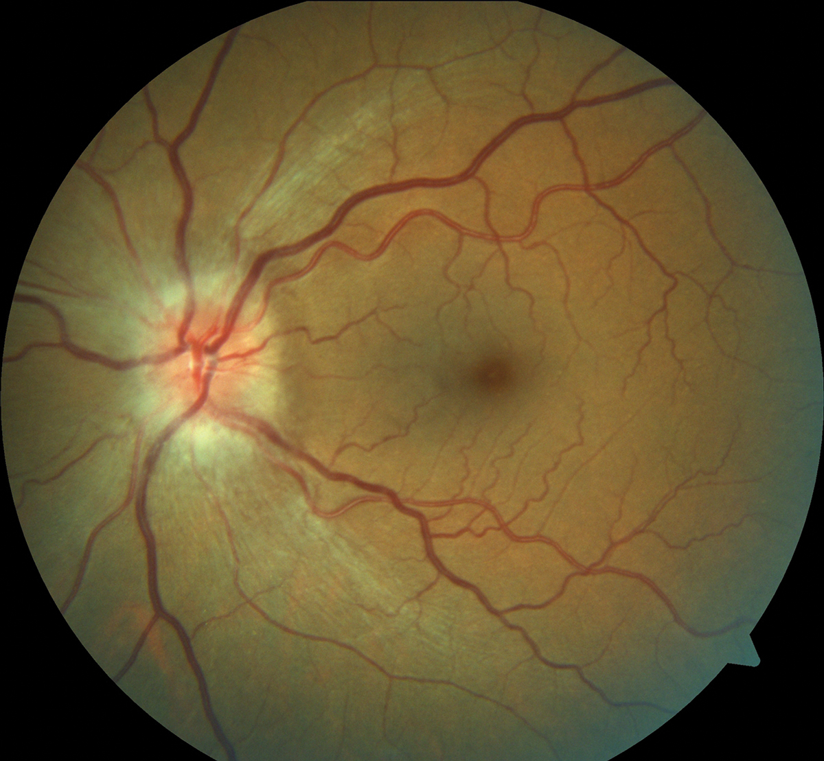 This NAION patient presented with significant optic nerve edema.