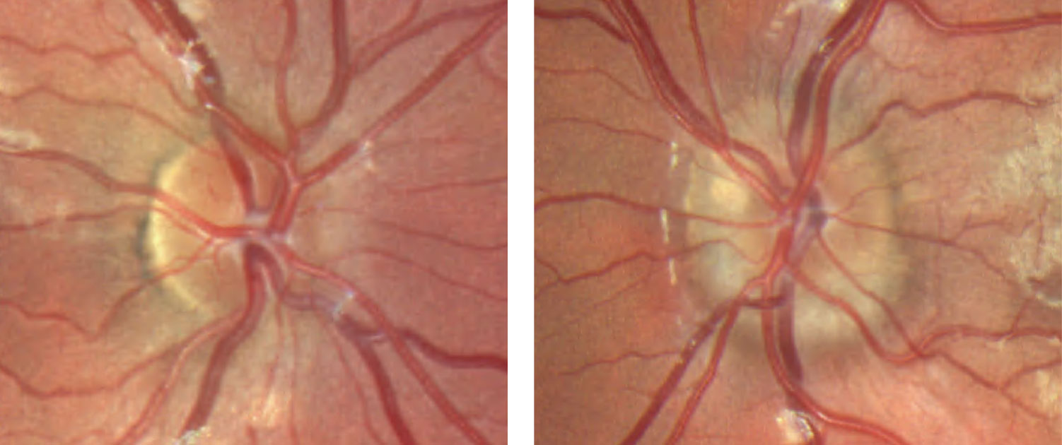 These color fundus photos of the optic discs show that the margins of the right optic disc, at left, are indistinct nasally but are otherwise preserved temporal. The left optic disc, at right, has more indistinct margins with a notable superficial druse superior nasal.