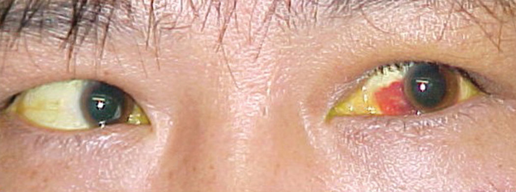 The patient’s left eye demonstrated subconjunctival hemorrhage and he reported double vision.