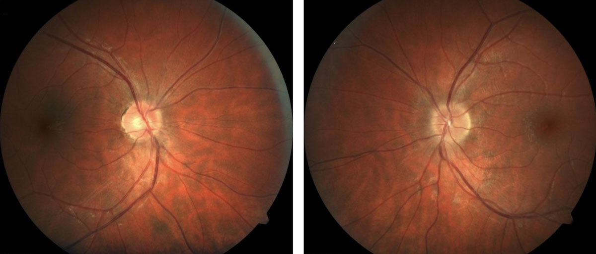 Patients with MS may present with retinal findings such as irregular or indistinct optic nerve margins.