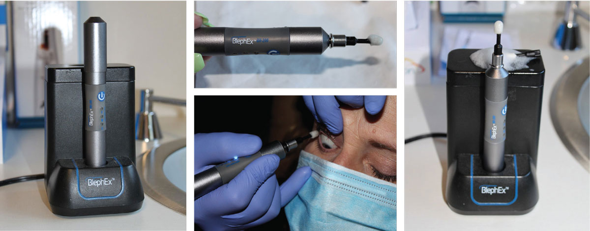 The BlephEx device for in-office removal of eyelid scurf and bacterial debris, which can cause inflammatory lid disease. The rotating pad buffs away the biofilm and other lid debris to prevent blepharitis.