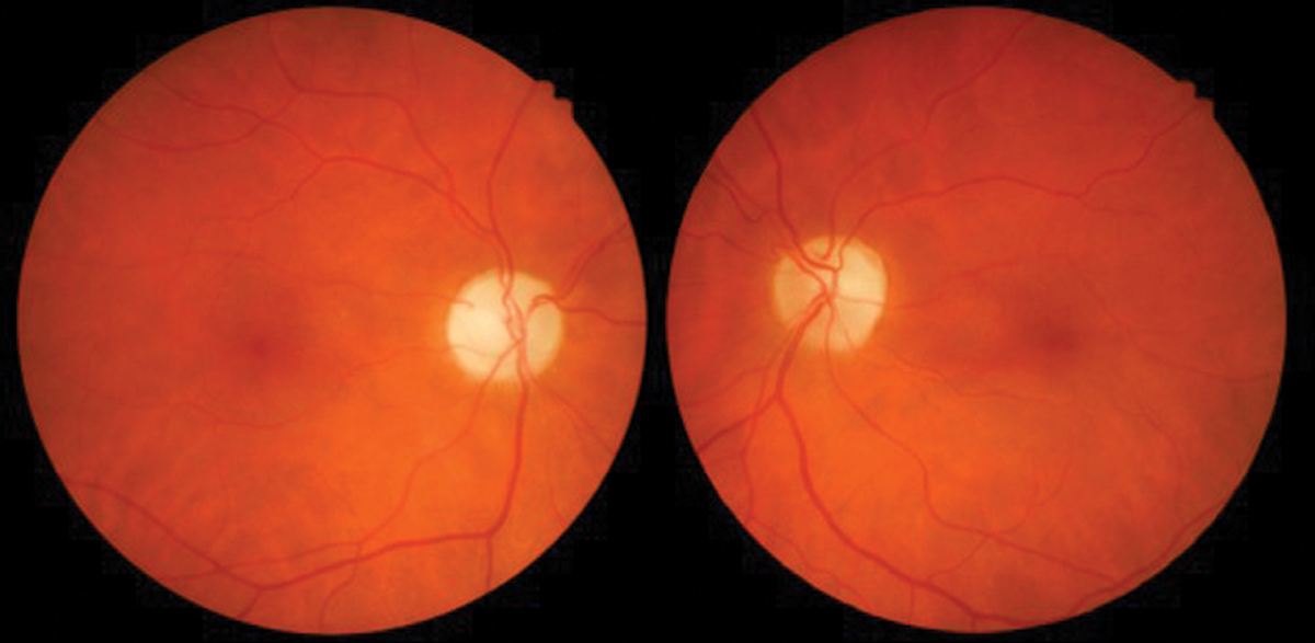 Fig. 7. Optic neuropathy with pallor OD>OS due to ethambutol.