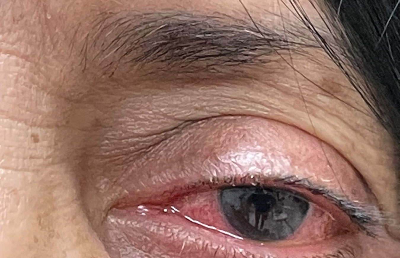 Hypersensitivity reaction of the left eye secondary to topical brimonidine use. Differentiating between a true type-1 hypersensitivity reaction or an IgE-mediated response and another type of adverse effect requires a careful discussion of symptoms the patient experienced with each reported adverse event.