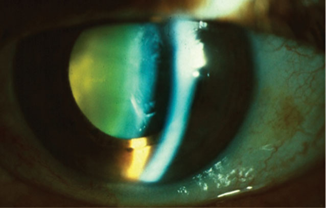 Crystalline lens yellowing is due to an accumulation of urochrome pigment in the lens. Anterior cortical cataract and nuclear sclerosis are pictured here.