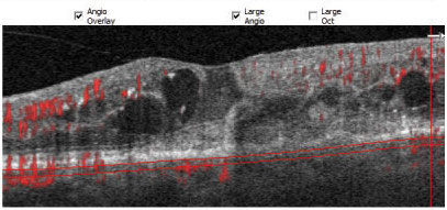 Researchers found that it was more beneficial to use OCT-A over other imaging methods when identifying and diagnosing patients with macular neovascularization. 