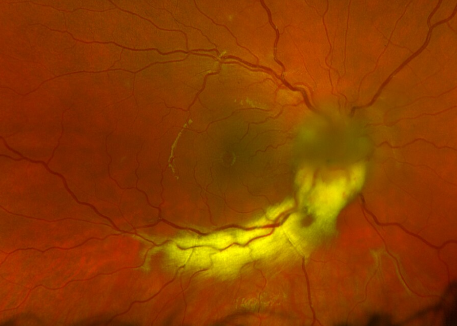Figure 1: Right eye with 4+ optic nerve head edema with overlying granuloma, cystoid macular edema, and myelinated retinal nerve fiber layer with possible retinitis.