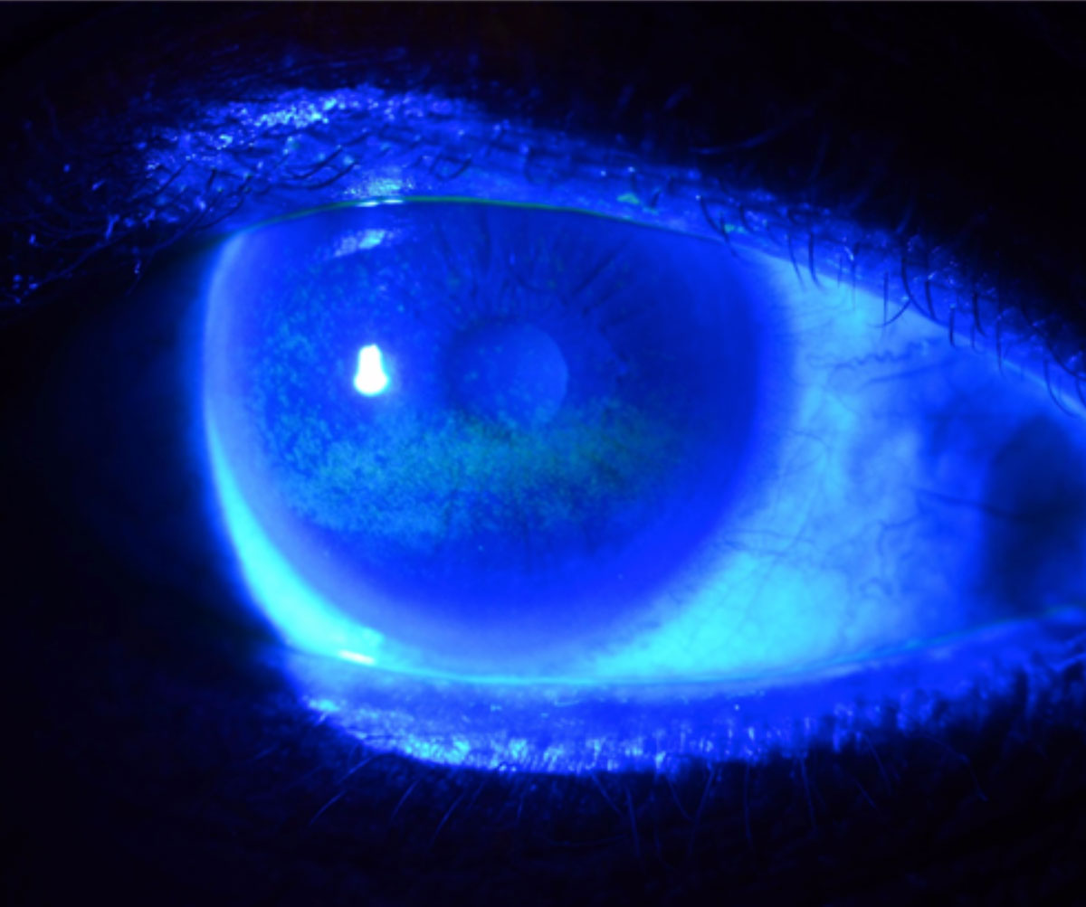 Punctate epithelial erosions in a dry eye patient as revealed by fluorescein dye.