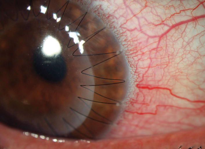 Over 70% of keratoconus patients experienced a two diopter or more increase in Kmax within five years of undergoing a PK.