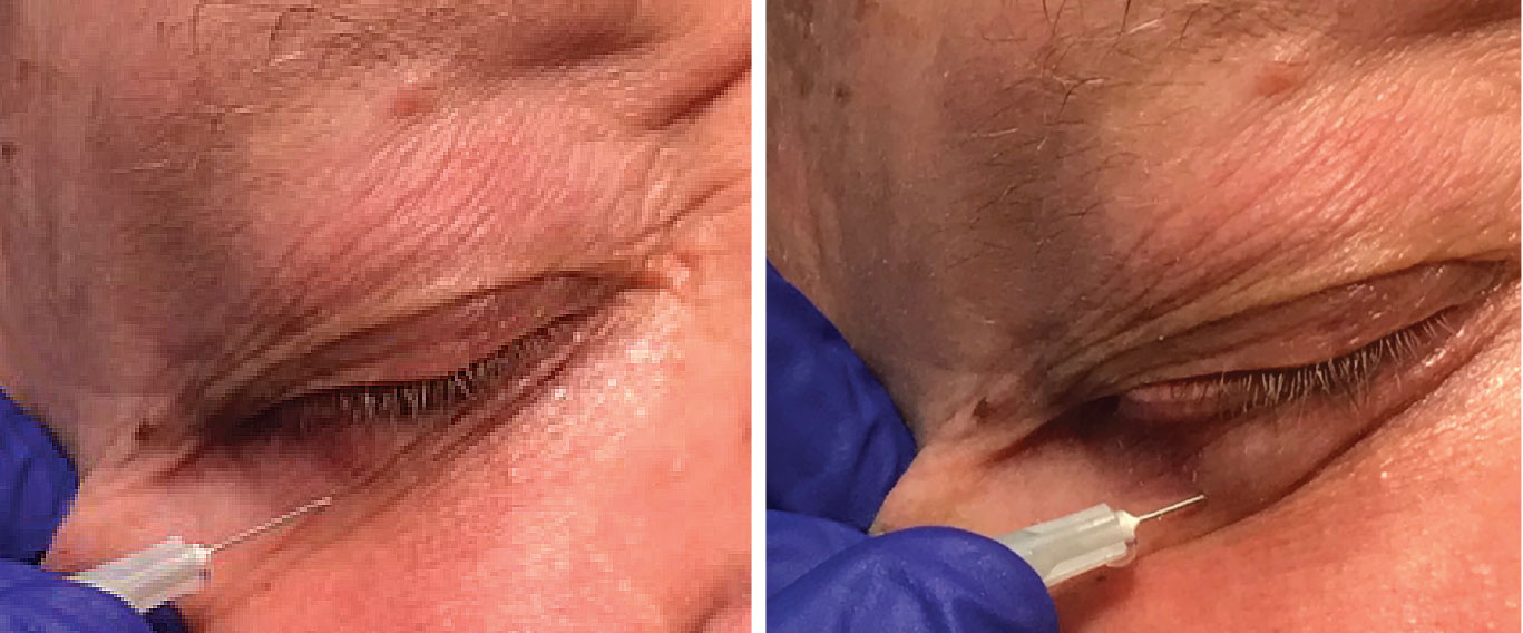 In the first image (left), lidocaine is injected in the lower left eyelid. Once the anesthetic is fully injected, you can see the area under the skin where the anesthetic fluid is (right).