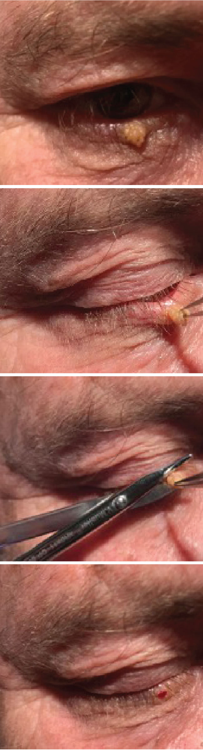 A small papilloma is removed from the lower right eyelid. The forceps are used to pull the lesion taut to provide a clear sight to the base of the lesion. The Wescott scissors are used to cut the lesion at the base. Once the lesion is removed, the patient is left with a flat, smooth surface. 