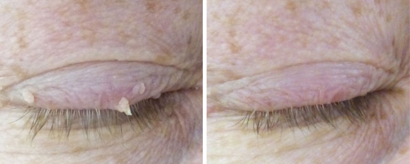 Here are a few small papillomas located on the upper eyelid before and after removal. For more, visit https://skinsurgeryclinic.co.uk/treatments/skin-tag-removal.
