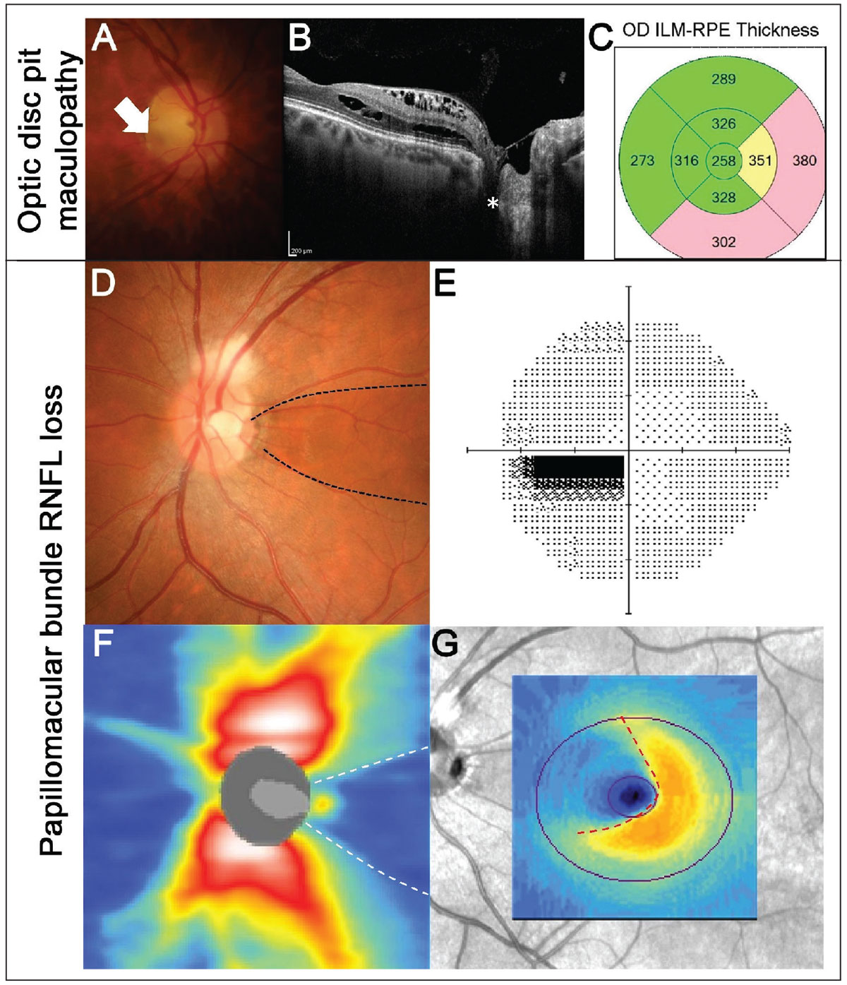 Fig. 2. Example of maculopathy associated with an optic disc pit. (A) Fundus photography shows an optic disc pit temporally (white arrow) in the right eye. (B) OCT line scans show the disc pit (white asterisk) with associated intraretinal fluid accumulation extending from the disc to the fovea. (C) EDTRS macular thickness grid shows thickening of the nasal and inferior subfields corresponding to the regions of fluid. (D-G) An example of papillomacular bundle loss associated with an optic disc pit (black dashed lines). (D) Fundus photography shows a temporal disc pit. Note there is also RNFL myelination superiorly. (E) A 24-2 visual field test showed a centrocecal defect in the left eye, corresponding to the RNFL defect. (F) OCT RNFL thickness heat map shows reduced RNFL thickness temporally (white dashed lines). (G) Macular ganglion cell analysis shows nasal loss (red dashed lines).