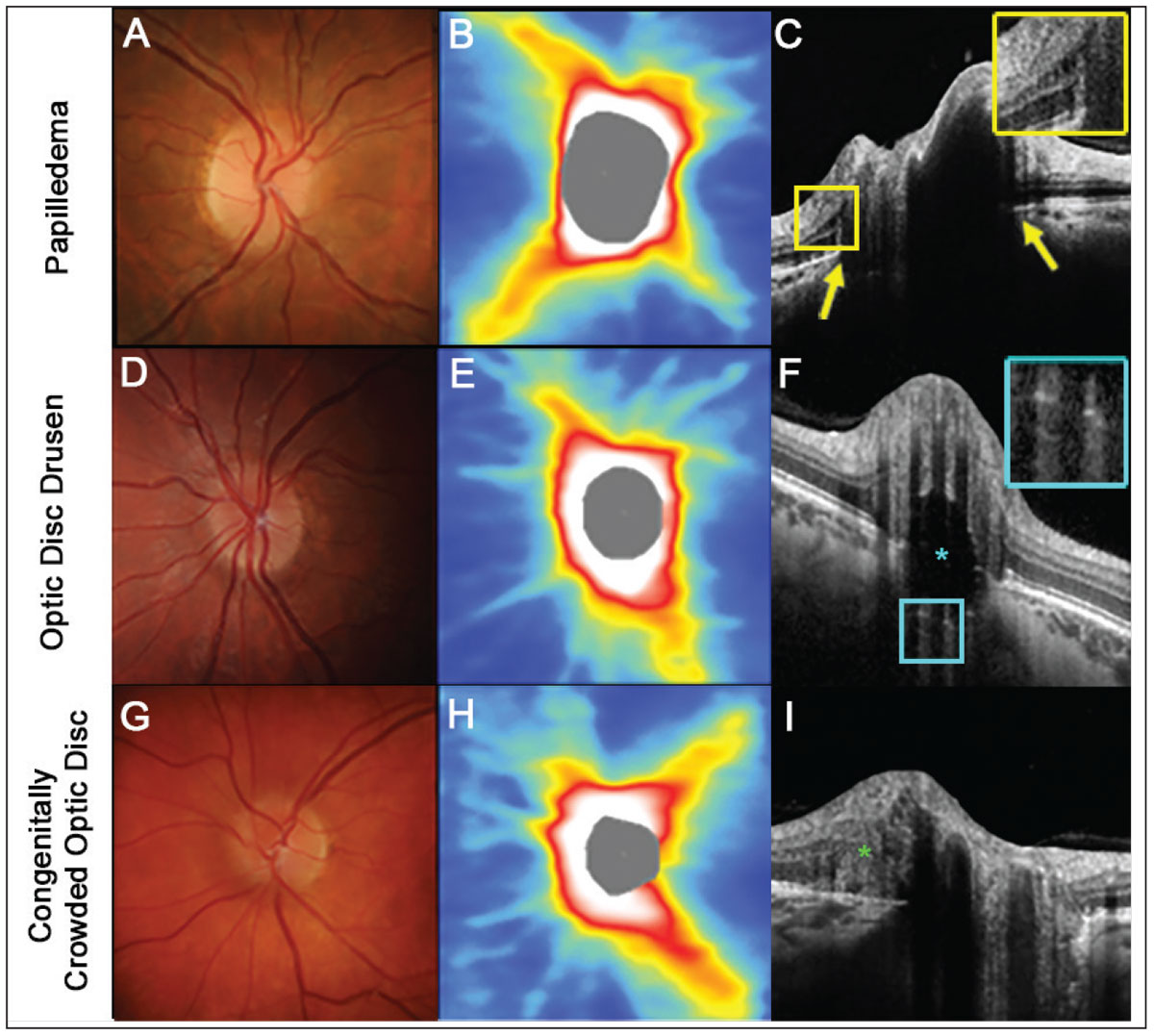 Fig. 4. An example of papilledema. (A) The right disc has minimal visible cup with some subtle blurring of the superonasal disc margin. (B) OCT thickness heat map shows thick superior and inferior RNFL. (C) A high-density OCT line scan shows anterior protrusion of Bruch’s membrane at its opening (yellow arrows) and intraretinal cystic spaces temporal to the disc margin (inset). (D-F) An example of optic disc seen more posteriorly within the optic nerve space (inset). (G-I). An example of a congenitally crowded optic disc. While the fundus photograph and OCT thickness heat map are similar to the other two conditions, there are no other features specific to these conditions visible on a high-density OCT line scan. Note that while a peripapillary hyper-reflective ovoid mass-like structure (PHOMS) can be noted at the nasal neuroretinal rim (green asterisk), this feature is non-specific to various causes of elevated optic discs (I).