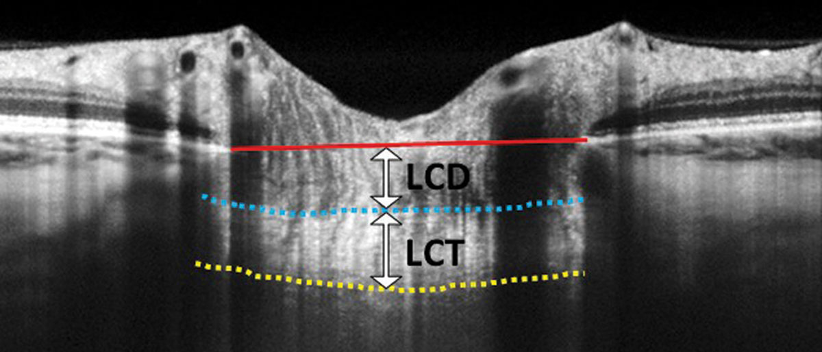 In this EDI-OCT through the optic nerve, the lamina cribrosa thickness (LCT) is measured from the anterior border (blue dashed line) to the posterior border (yellow dashed line) of the lamina cribrosa. Lamina cribrosa depth (LCD) is measured along a perpendicular line from the anterior border of the lamina to a reference line that connects the edges of Bruch’s membrane (red solid line).